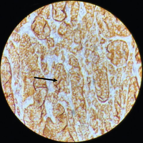 Immunohistochemistry showed chromogranin strongly diffuse positive magnification is ×100 used is chromogranin.